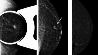 contrast-enhanced digital mammography
