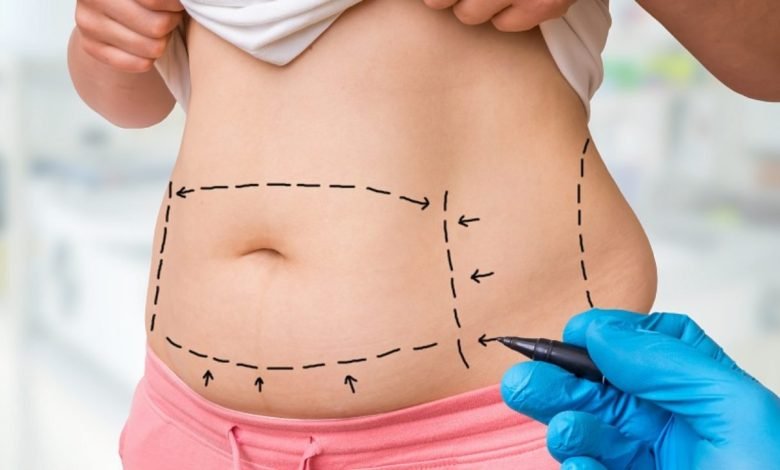difference between liposuction and tummy tuck