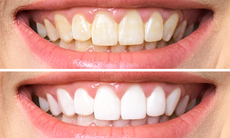 teeth whitening with crowns