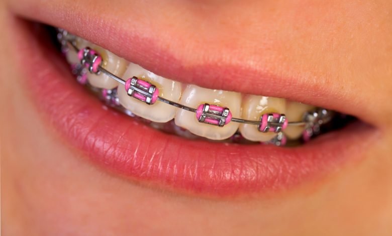 dental braces near me